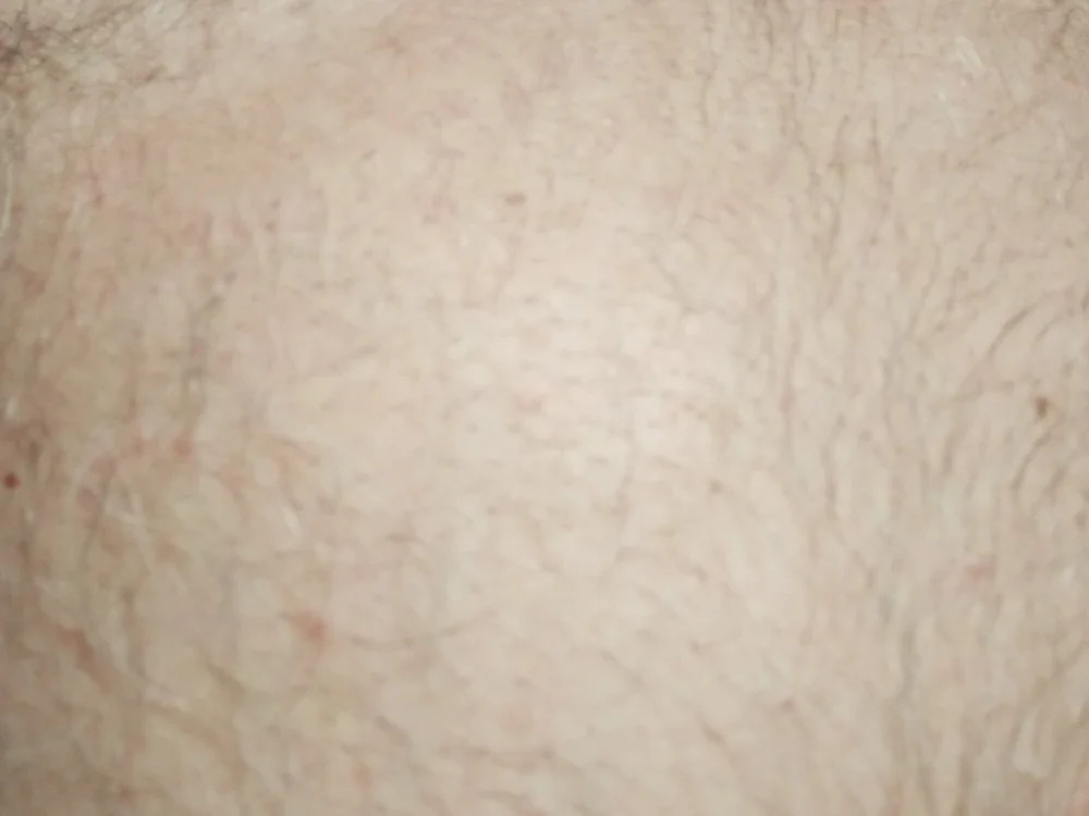 Ficose